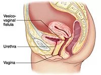 Urinary fistula
