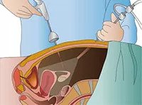 Laparoscopy Surgery