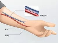 Renal Transplant/AV fistula/CAPD catheter