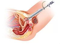 Prostate surgery by laser