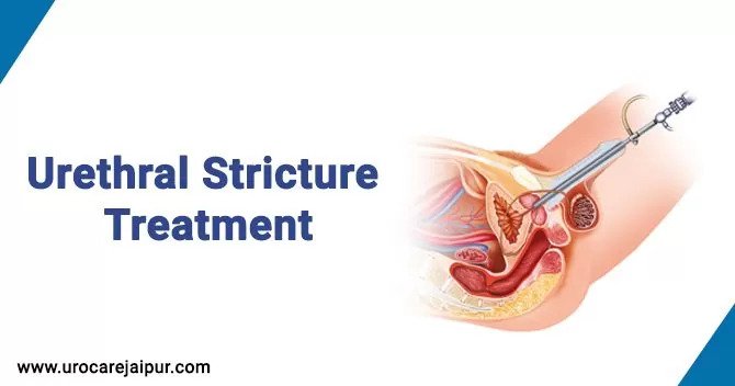 urethral-stricture-treatment